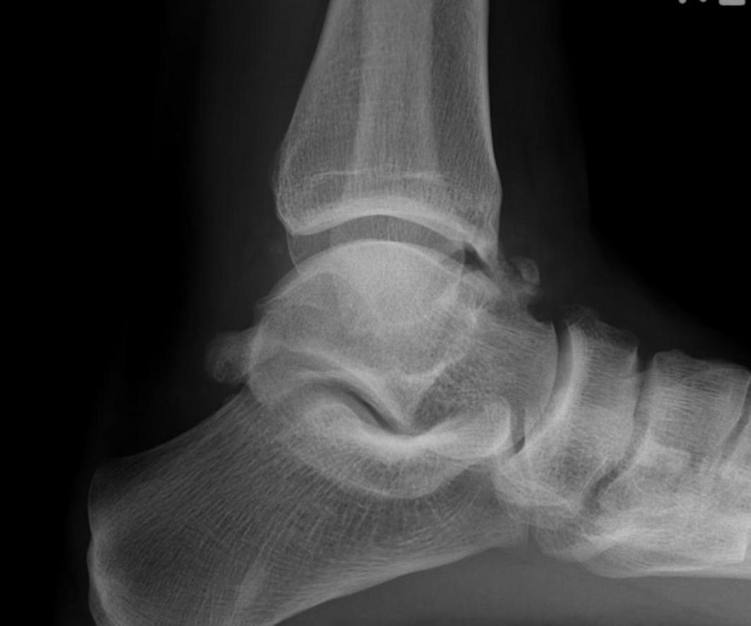 Ankle Xray Anterior Tibial Osteophyte